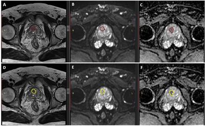 Frontiers | MRI Radiomics In Prostate Cancer: A Reliability Study